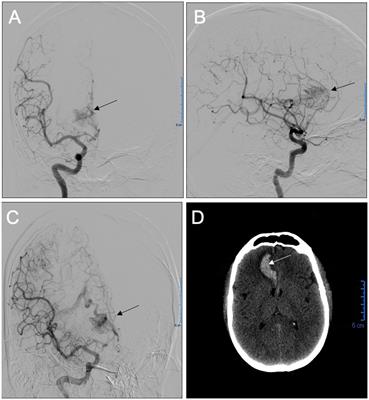 Case report: A combination of nitroglycerin and adenosine proves effective in repairing a cerebral arteriovenous malformation